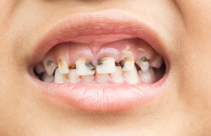 5 Most Common Dental Problems in Kids