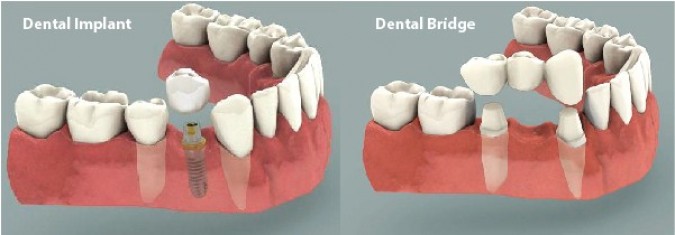 Dental bridge vs Implant . Which one should I get? Dental bridge vs Implant . Which one should I get?