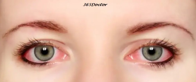 Eye Flu Treatment in Hindi Eye Flu Treatment in Hindi