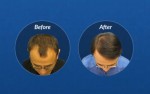 FUE Hair Transplant Surgery FUE Hair Transplant Surgery
